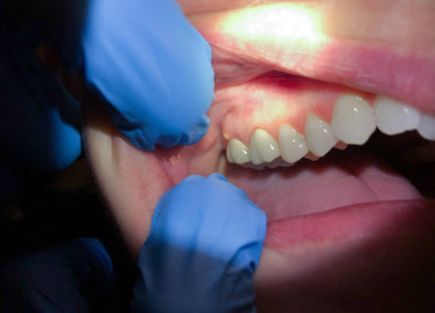 Best Emergency Dental Care for Abscessed Tooth in Westlake, TX